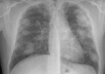 CFMEU demands action on silicosis